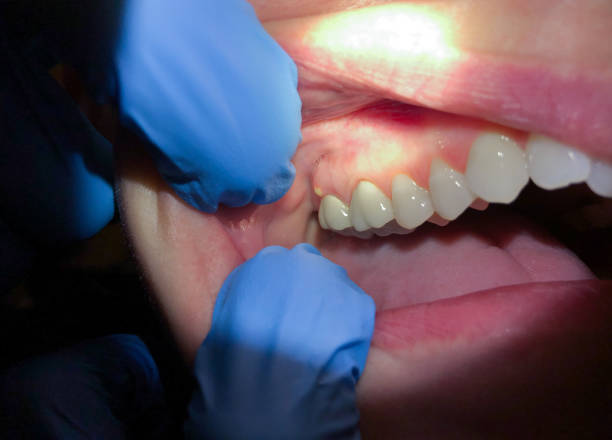 Best Knocked-Out Tooth Emergency  in Marlinton, WV
